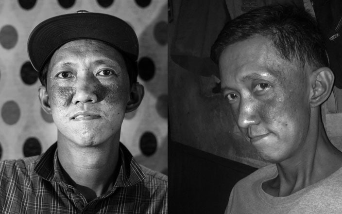Eugene post chemo and radio therapy (Left). How Eugene looked like back in July at the height of his cancer treament (Right).